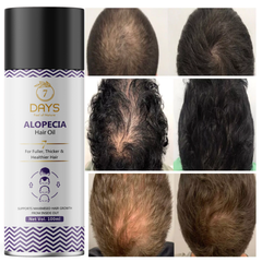 Alopecia Hair oil with Ginger, Onion, Shikakai for Hair Gowth Stop Hair Fall Hair Oil (100 ml)